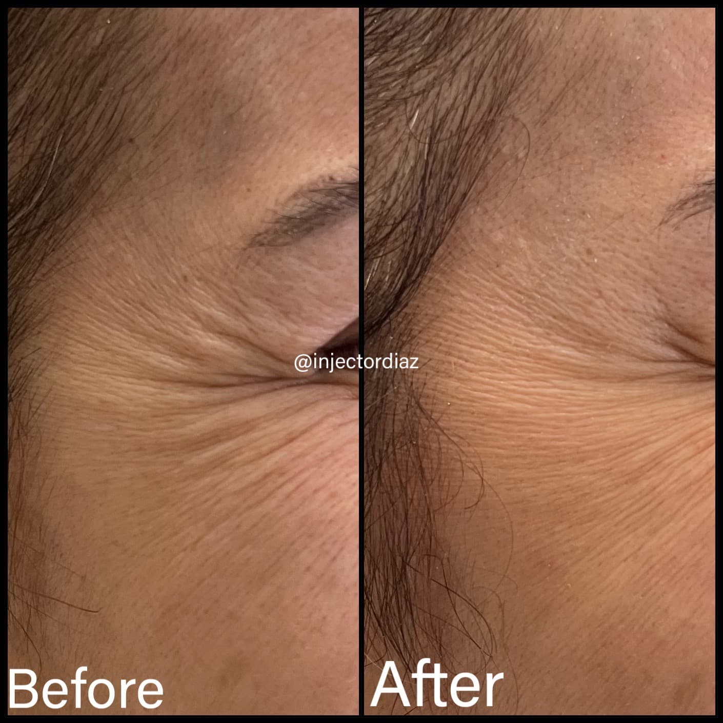 Before and after: Before and after results of neurotoxin injections crows feet
